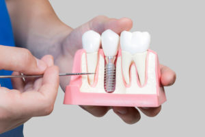 Dental Assistant Showing Off A Dental Implant In A Jawbone Cutaway Model in Mission Viejo, CA