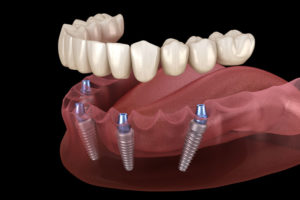 image of full mouth dental implants with the titanium posts