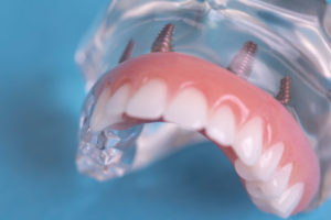 A picture of a full mouth dental implant model