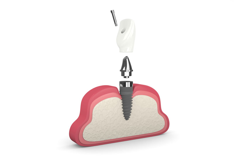 a single dental implant model showing the implant post inside the gum model with the abutment and dental prosthesis hovering over it.