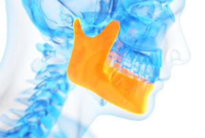 a dental implant xray of a jaw showing bone grafting.