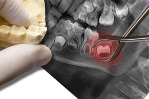 an xray of an impacted wisdom tooth ready for extraction.