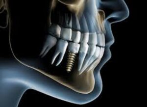 An image of an x ray and dental implant.