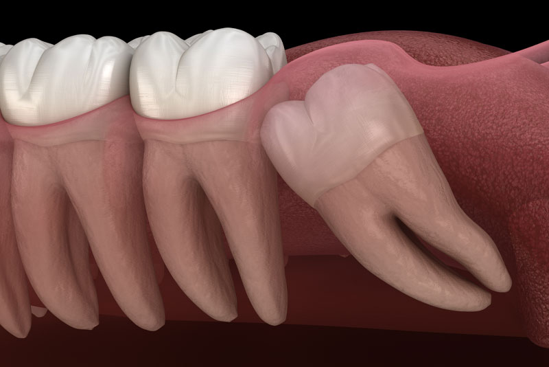 An image of a wisdom tooth that needs removed.