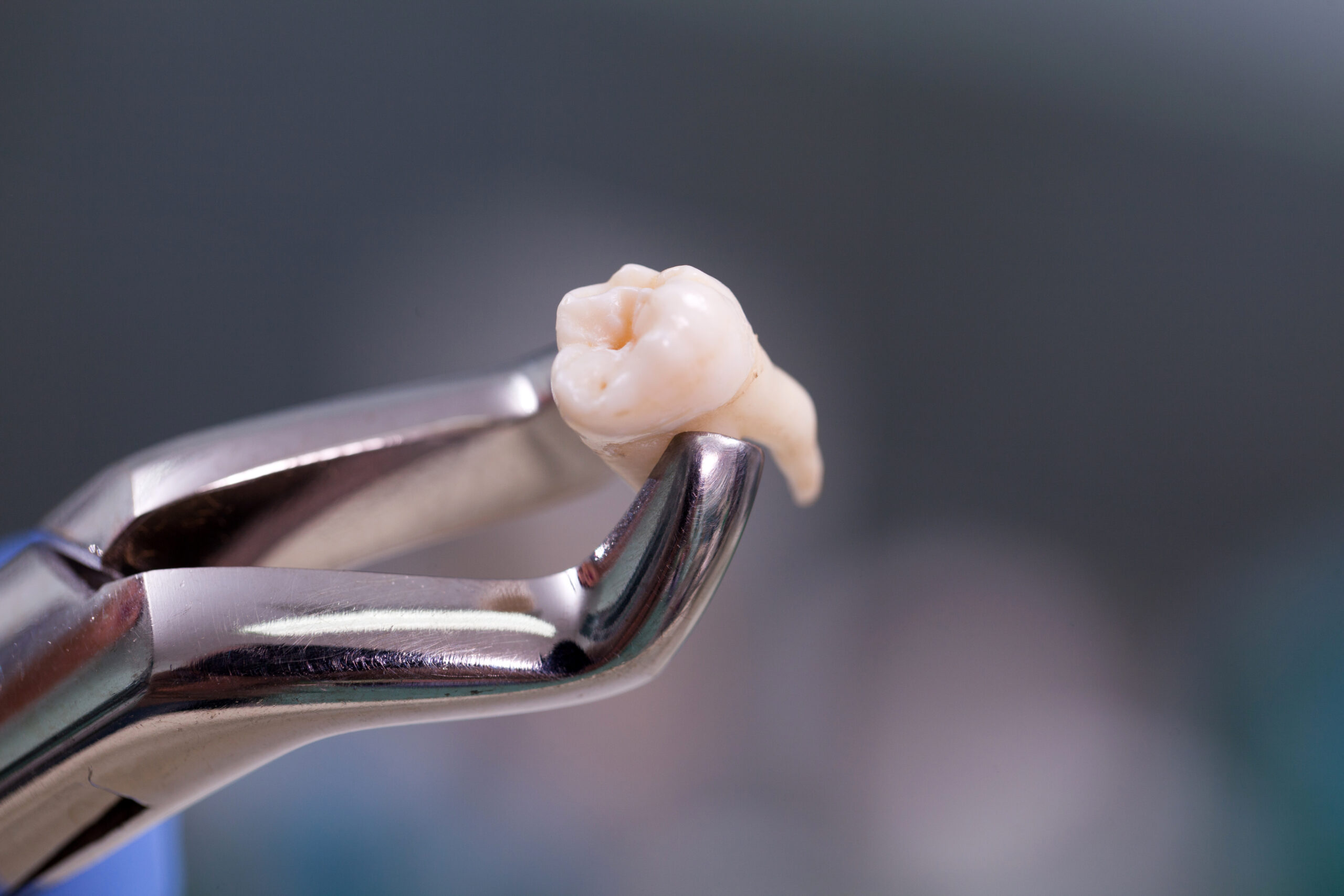 Wisdom Tooth Removal In Mission Viejo, CA.