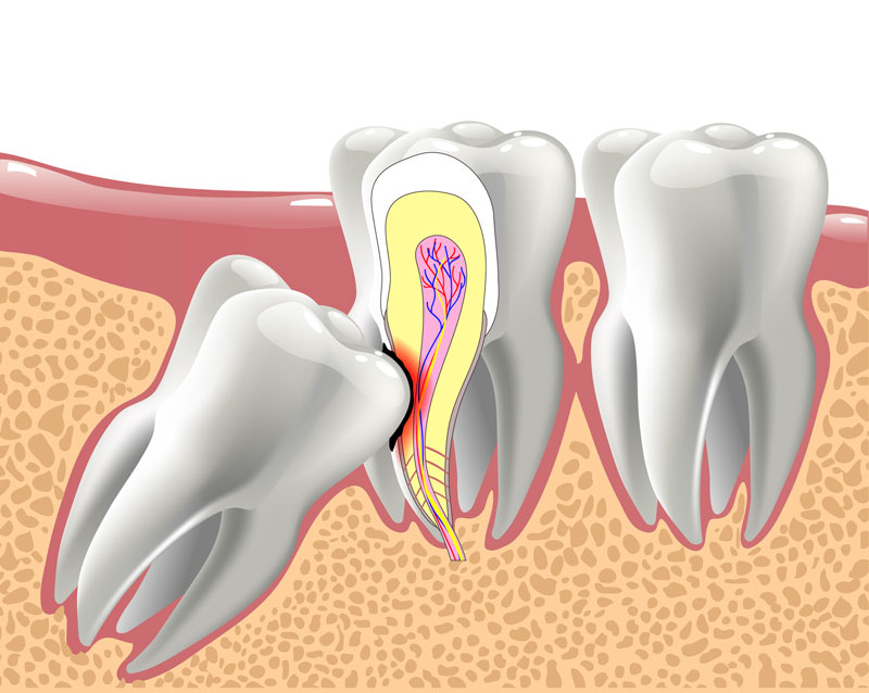 A 2d image showing a wisdom tooth causing discomfort.