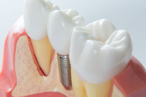 3d model of a dental implant.