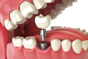 a full mouth model showing a dental implant and dental implant post.