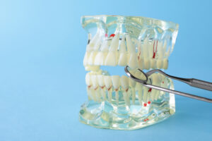 a full mouth dental implant prosthesis model.