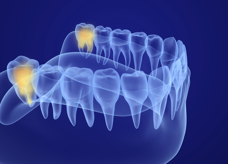 Wisdom tooth x-ray view. Medically accurate tooth 3D illustration.